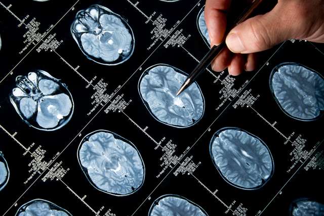 New Drug Delays Progression of Glioma, a Deadly Brain Cancer